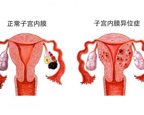 无创介入输卵管手术安全吗？助孕医院排名与费用解析